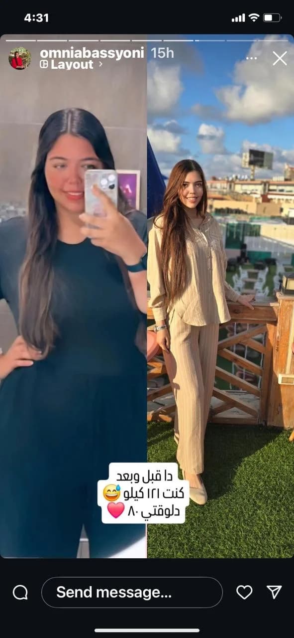 قبل و بعد تكميم المعده المغلف (اكثر أماناً)