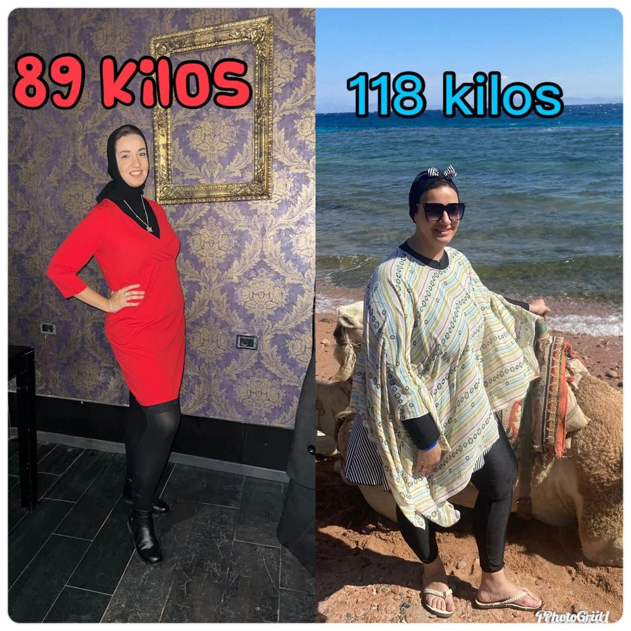 قبل و بعد طي المعده خلال 6 أشهر