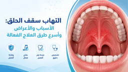 التهاب سقف الحلق
