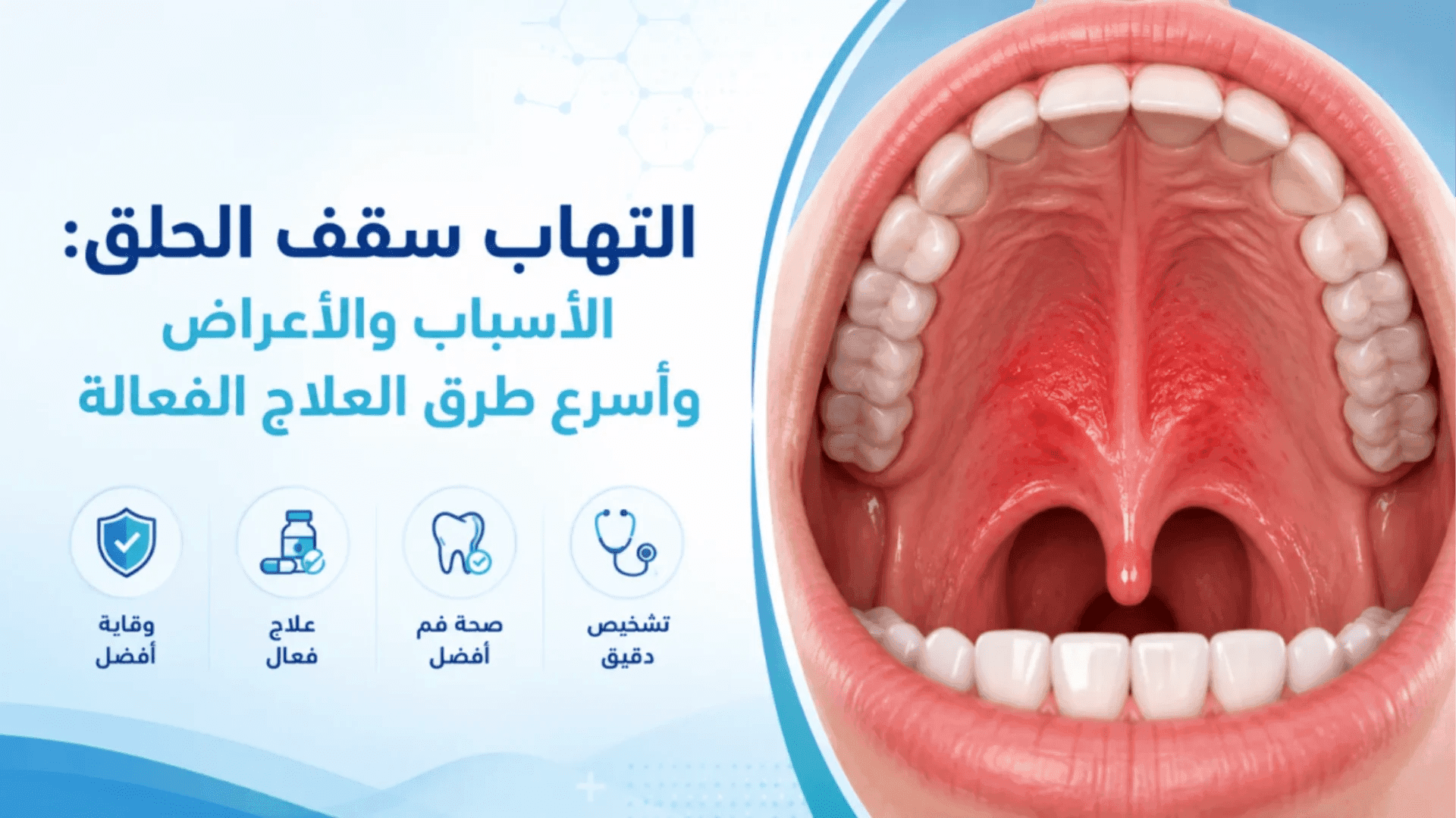 الدليل الشامل لإلتهاب سقف الحلق مع اهم الأسباب وطرق العلاج الفعالة