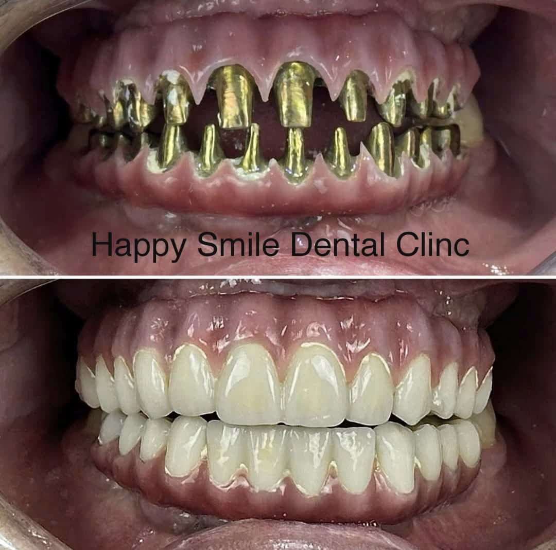 🦷✨ من أسنان متهالكة ومفقودة إلى ابتسامة طبيعية وثقة كاملة بالنفس!  شاهدوا الفرق الحقيقي قبل وبعد العلاج في عيادة هابي سمايل للأسنان. 👌  في هابي سمايل بنوفر أحدث حلول زراعة الأسنان والتركيبات الثابتة