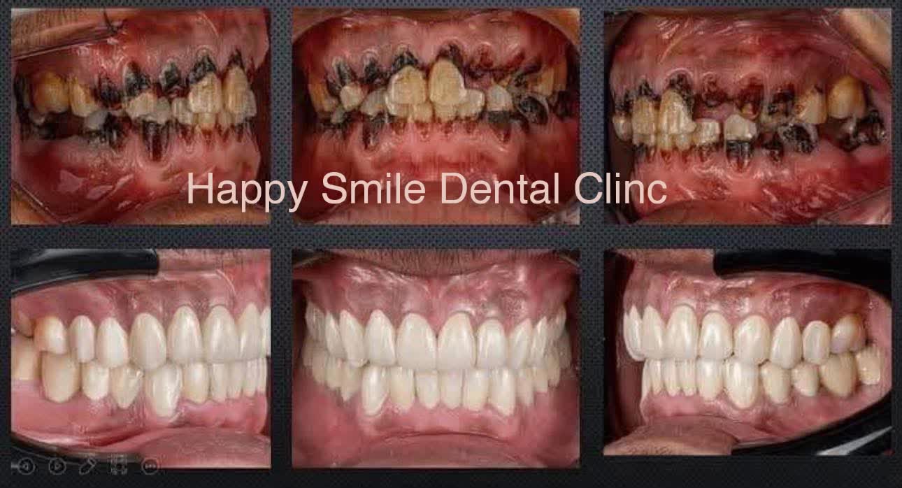 ✨ قبل وبعد عدسات الفينير التجميلية  فرق واضح في لون الأسنان، الشكل، وتناسق الابتسامة في جلسات بسيطة ونتائج طبيعية جذابة.  📍 هابي سمايل للأسنان – المرج 📞 01142778705  فينير عدسات_تجميلية ابتسامة