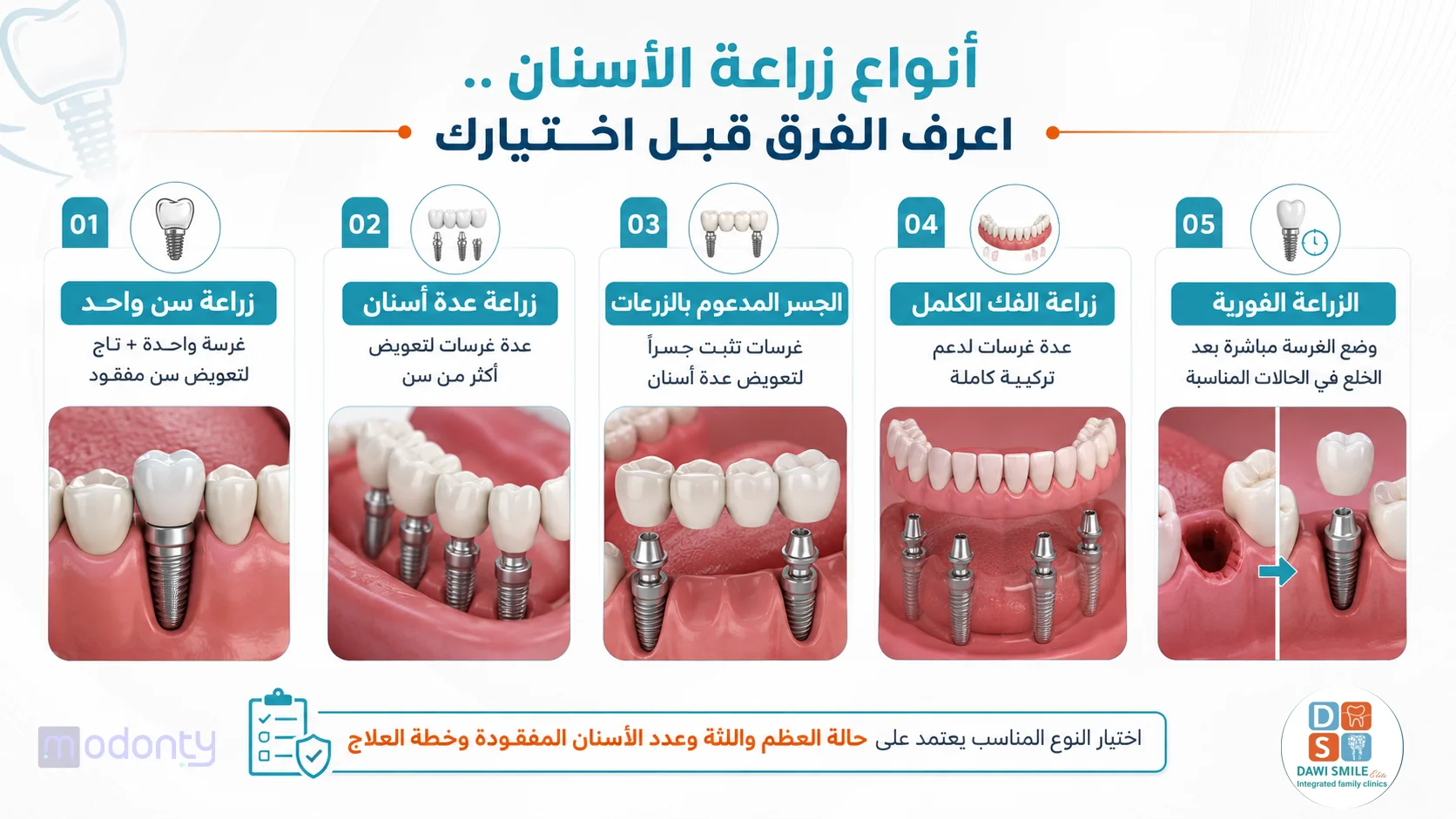 أنواع زراعة الأسنان في مصر واسعارها
