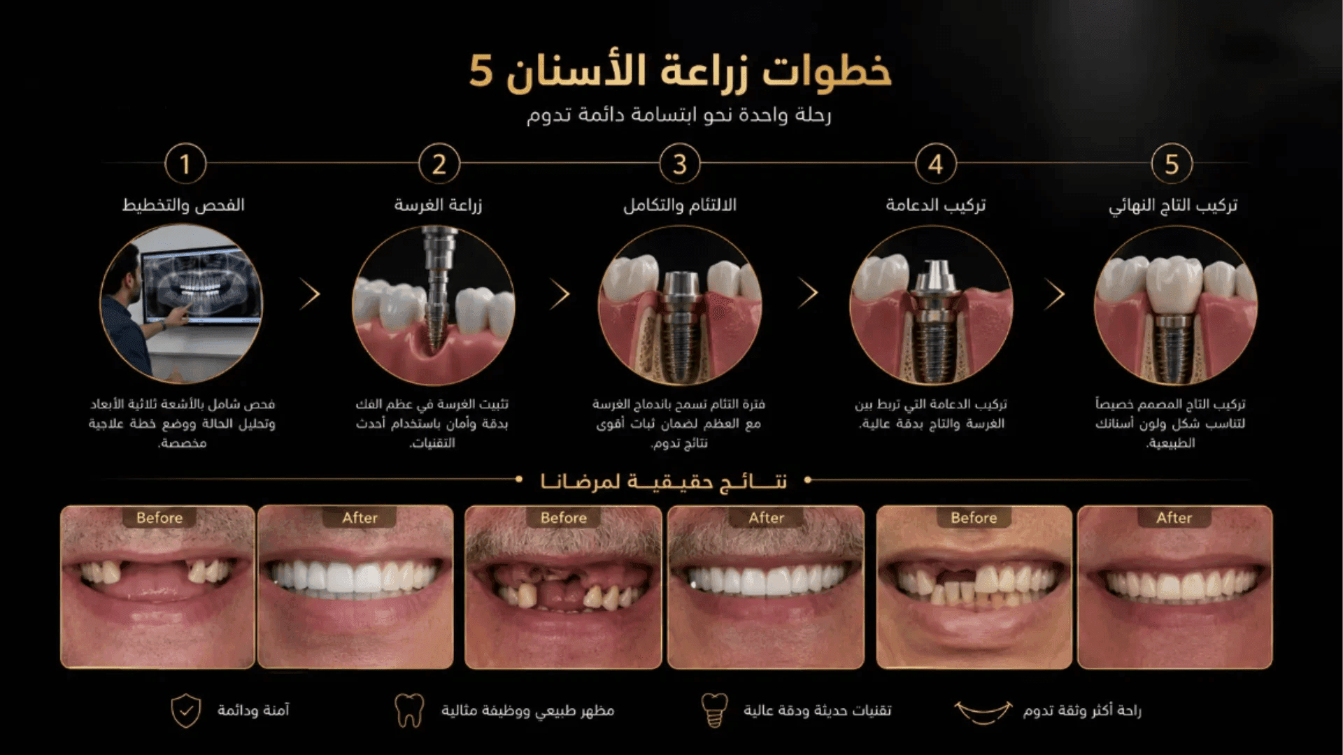 مراحل زراعة الأسنان في مصر خطوة بخطوة مع دكتور عمر الديدي، من الفحص وتركيب الغرسة حتى التاج النهائي مع نتائج حقيقية قبل وبعد العلاج