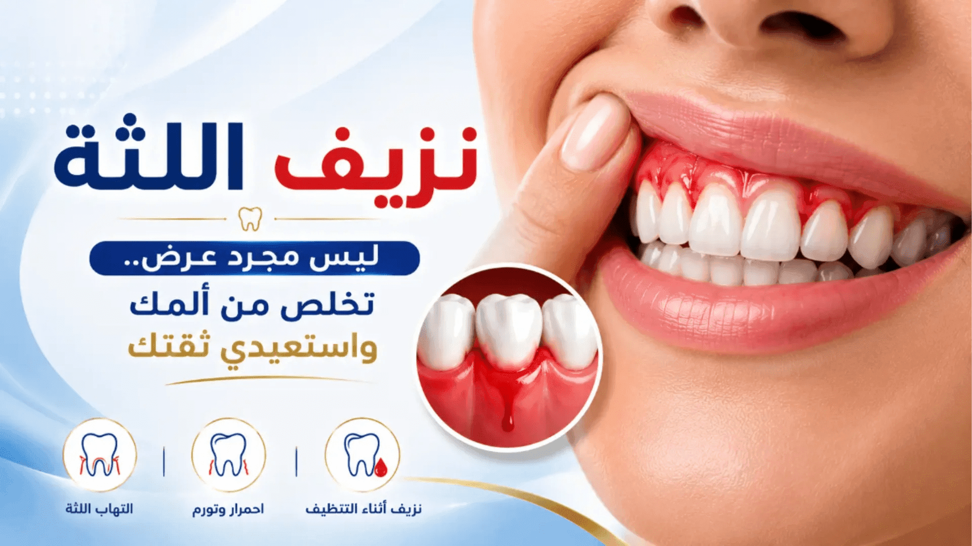 علاج التهاب اللثة الشديد وانتفاخها في عيادة هابي سمايل | استعد صحة لثتك وابتسامتك