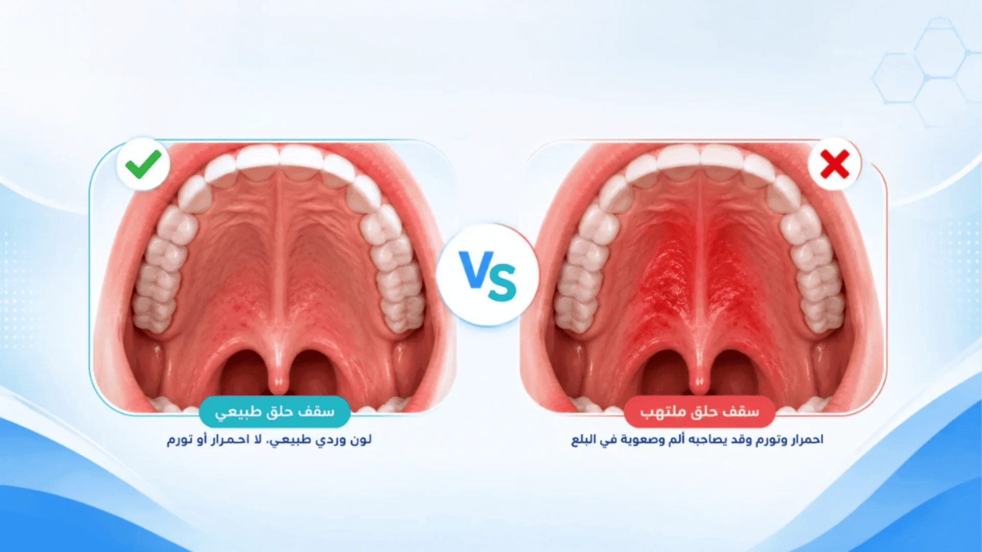 الفرق بين سقف حلق ملتهب وسقف حلق طبيعي