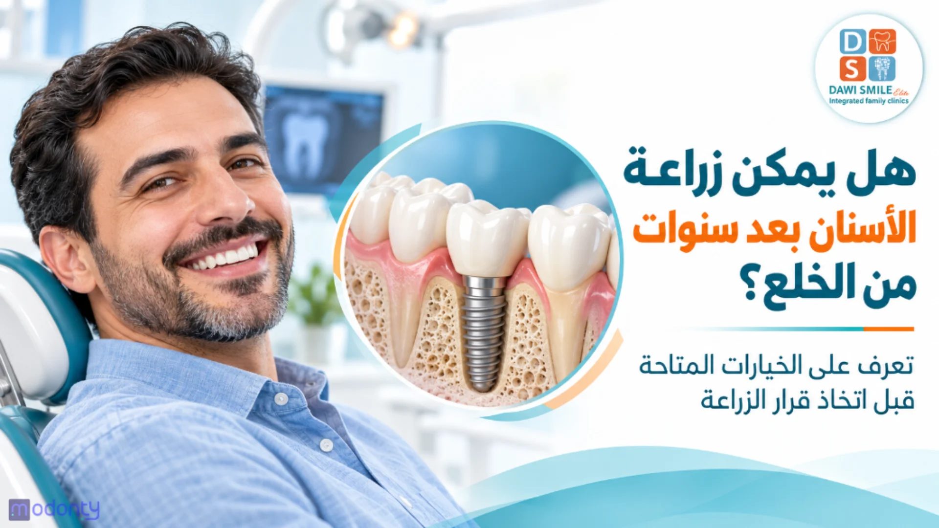 هل يمكن زراعة الأسنان بعد سنوات من الخلع