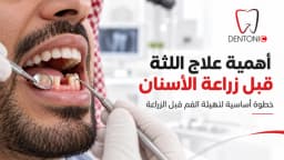 أهمية علاج اللثة قبل زراعة الأسنان | لماذا يعتمد نجاح الزراعة على صحة اللثة؟