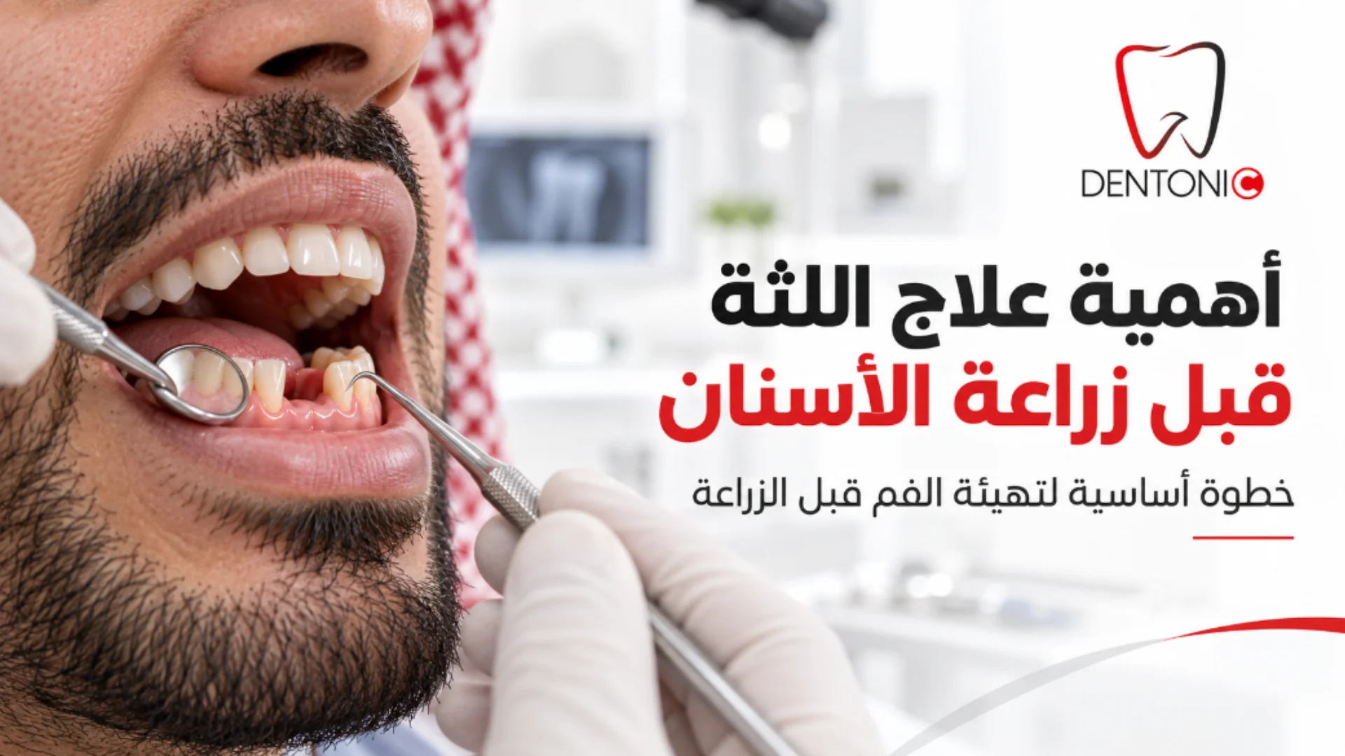 أهمية علاج اللثة قبل زراعة الأسنان | لماذا يعتمد نجاح الزراعة على صحة اللثة؟