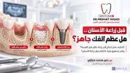 من يحتاج زراعة عظم قبل زراعة الاسنان ؟ الحالات والمدة وما يجب معرفته