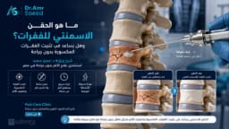 ما هو الحقن الاسمنتي للفقرات ؟ وكيف يساعد في تثبيت الفقرات المكسورة بدون جراحة؟