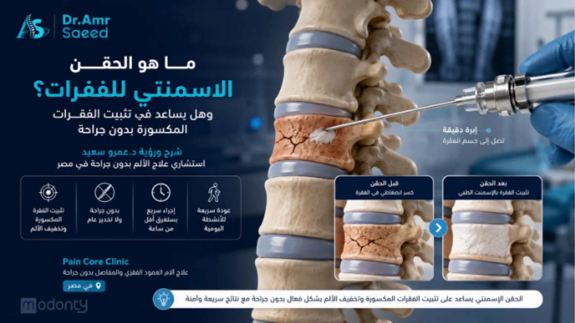 ما هو الحقن الاسمنتي للفقرات ؟ وكيف يساعد في تثبيت الفقرات المكسورة بدون جراحة؟