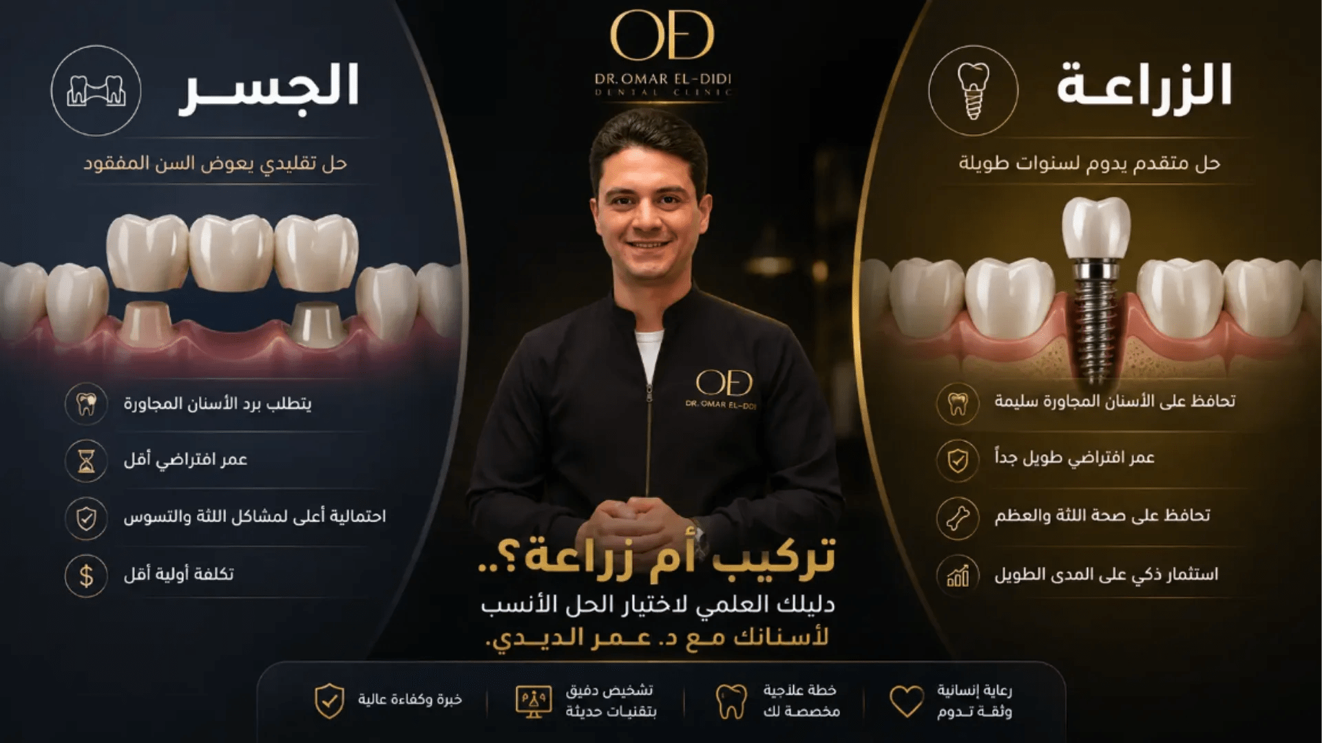 مقارنة بين زراعة الأسنان والجسر التقليدي لتوضيح الفرق في تعويض الأسنان المفقودة.
